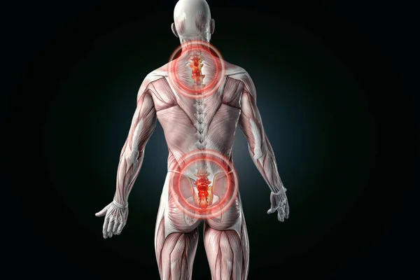 Анатомическая Боль Спине Иллюстрация — стоковое фото