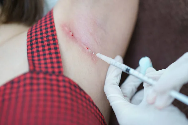 Closeup Doctor Injection Treatment Keloids Armpit —  Fotos de Stock