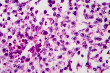 Testis seminomu, ışık mikrografı