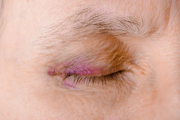 Injured Eye Due Capillary Rupture — Fotografia de Stock