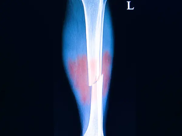 Fractures Leg Bones Ray Background Close — Stock Photo, Image