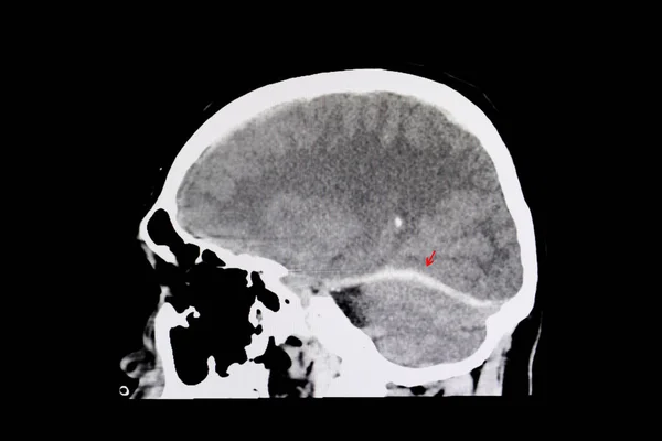 Röntgen Der Intrazerebralen Blutung Hintergrund Nahaufnahme — Stockfoto