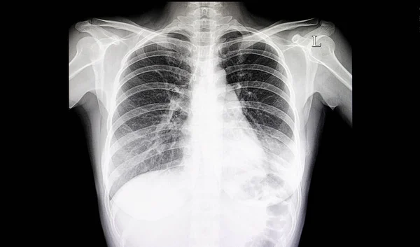 Pneumonia Chest Film Ray Background Close — Stock Photo, Image