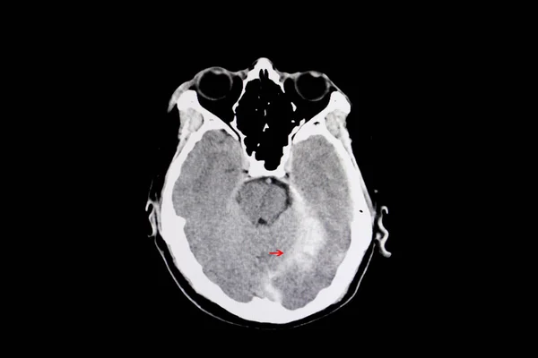 バックグラウンド上の脳内出血X線 閉じる — ストック写真