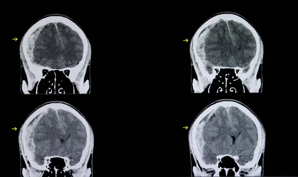 Hersenen Subarachnoïdale Bloeding Ray Achtergrond Close — Stockfoto