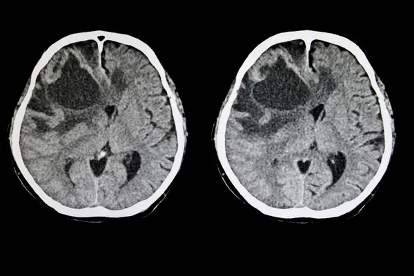 Tumeur Cérébrale Métastatique Radiographie Sur Fond Gros Plan — Photo