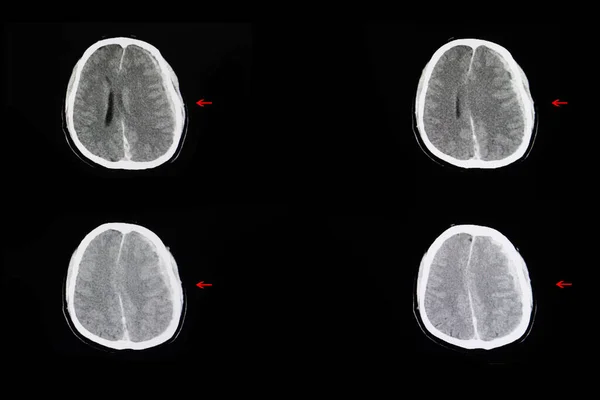 脳内出血および脳浮腫について — ストック写真