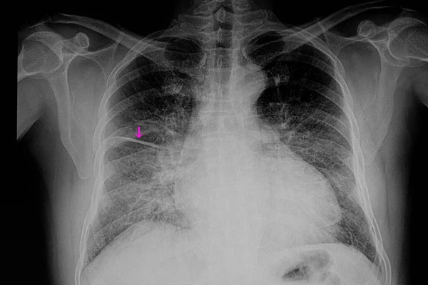 Insuficiencia Cardiaca Congestiva Edema Pulmonar Imagen Exploración — Foto de Stock