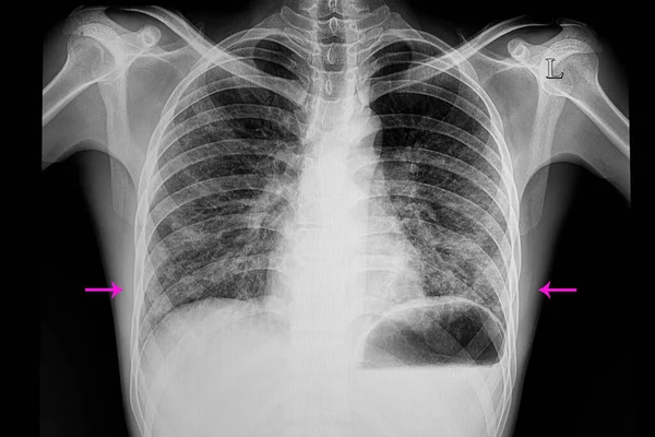 Çift Taraflı Alt Akciğer Zatürresi — Stok fotoğraf