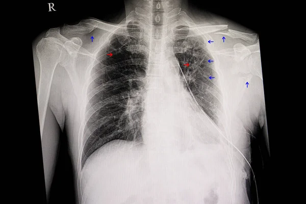 Chest Film Multiple Fracture — Stock Photo, Image