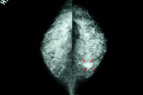 Mamogram Ženských Prsou Scan Image — Stock fotografie
