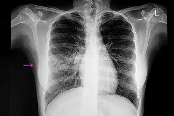 Oikea Keskimmäinen Lohko Keuhkokuume Röntgenkuva Taustalla Lähikuva — kuvapankkivalokuva