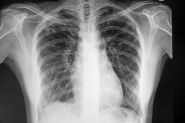 Röntgen Der Lungentuberkulose Hintergrund Nahaufnahme — Stockfoto
