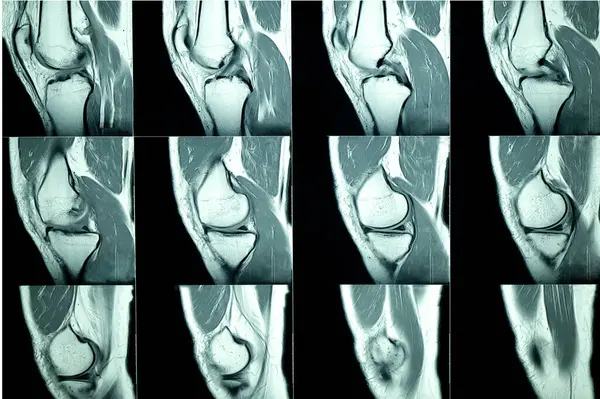 MRI scan of a patient knee x-ray
