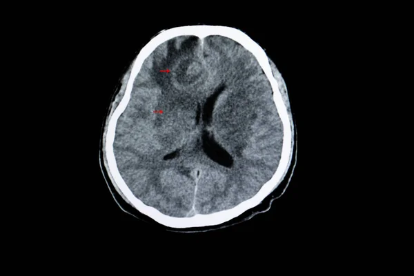 Infecção Por Toxoplasmose Cerebral Imagem Varredura — Fotografia de Stock