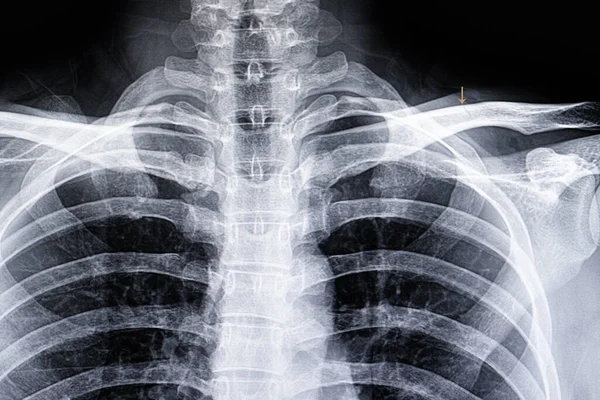 Hairline Fracture Clavicle — Stock Photo, Image