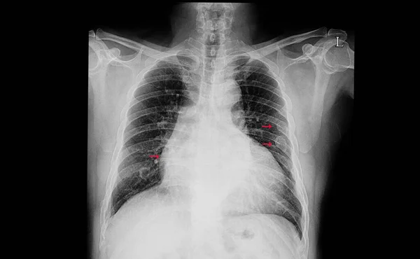 Cardiomegalia Múltiples Fracturas Costillas Imagen Escaneada — Foto de Stock