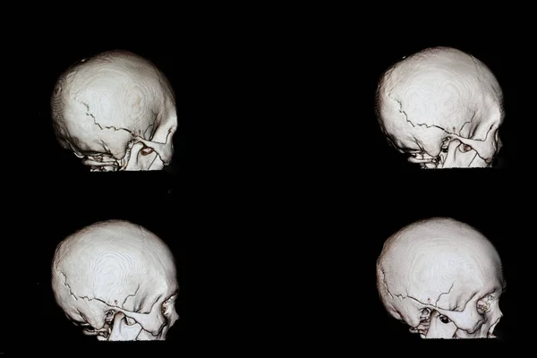 Fractured Skull Film Ray Background Close — Stock Photo, Image