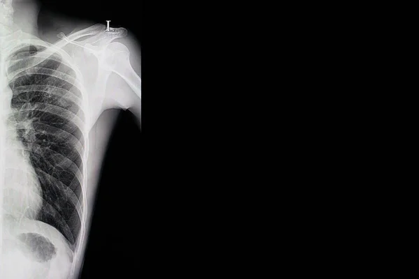 Lungentuberkulose Scanbild — Stockfoto