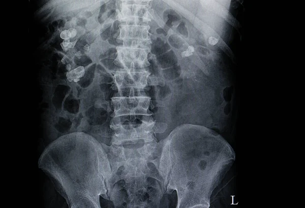 Kidney Stones Scan Image — Stock Photo, Image