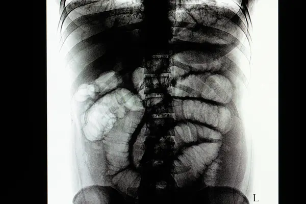 Pellicola Intestinale Ileo Radiografia Sullo Sfondo Primo Piano — Foto Stock