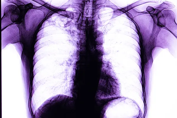 Pulmonary Tuberculosis Film Ray Background Close — Stock Photo, Image