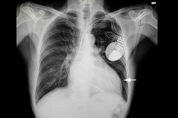Kalp Büyütme Kalp Pili Olan Bir Hasta — Stok fotoğraf