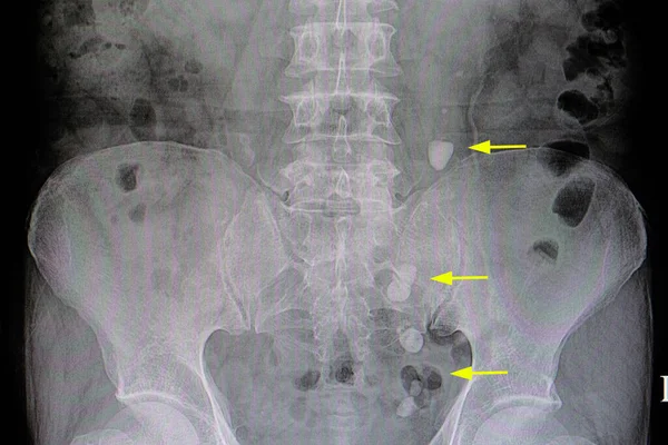 Xray Film Patient Ureteric Stones — Stock Photo, Image
