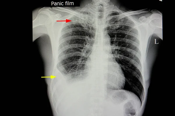 Gruźlica Płuc Wysiękiem Opłucnowym — Zdjęcie stockowe