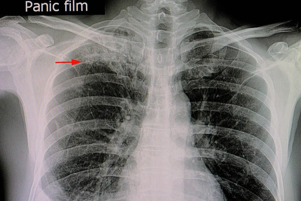 Lungentuberkulose Der Rechten Oberen Lunge — Stockfoto