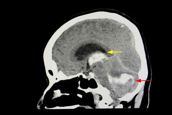 Felç Hastasının Beyin Taraması — Stok fotoğraf