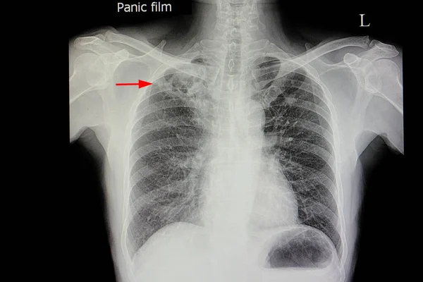 Plicní Tuberkulóza Pravé Horní Plíci — Stock fotografie
