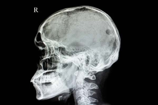 颅骨缺损 扫描图像 — 图库照片