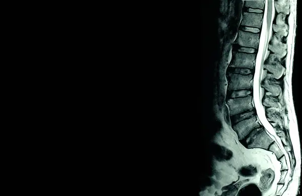 MRI scan of lumbar spines of a patient with chronic back pain