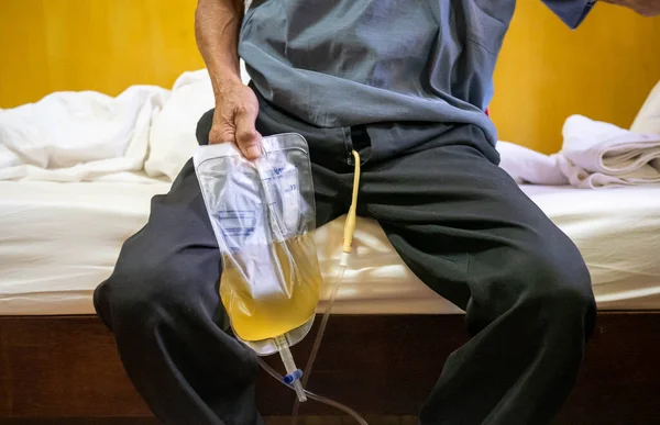 Asian Old Man Enlarged Prostate Gland Needs Inserted Urinary Catheter — Stock Photo, Image
