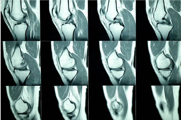 Mri Scan Patient Knee Ray — Stock Photo, Image