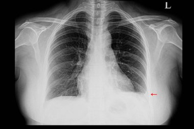 A chest xray of a patient with left pleural effusion