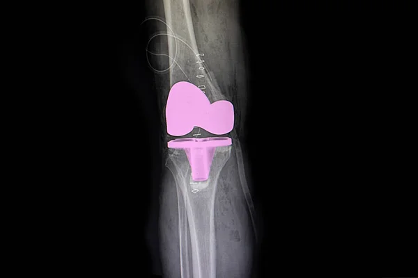 Total Knee Arthroplasty Ray Background Close — Stock Photo, Image