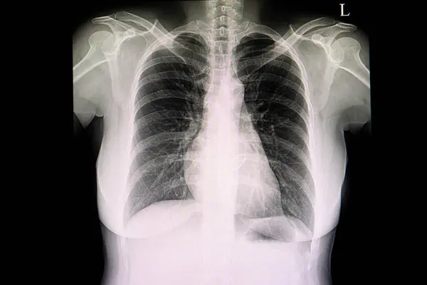 Protes Ventil Röntgen Bakgrunden Närbild — Stockfoto