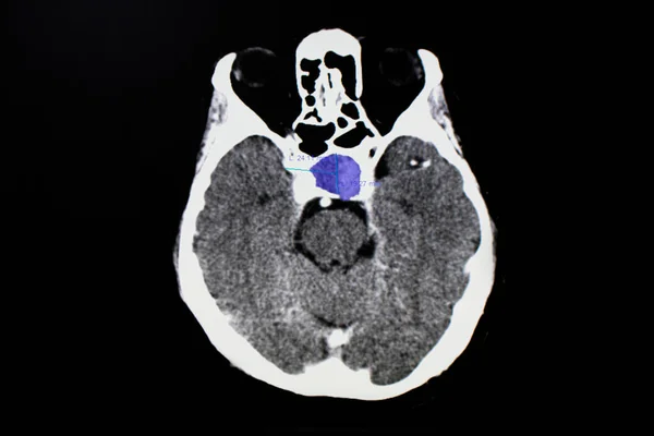 Рентген Piuitary Опухоли Заднем Плане Крупным Планом — стоковое фото