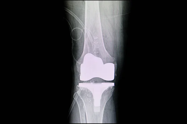 Total Knee Arthroplasty Ray Scan — Stock Photo, Image