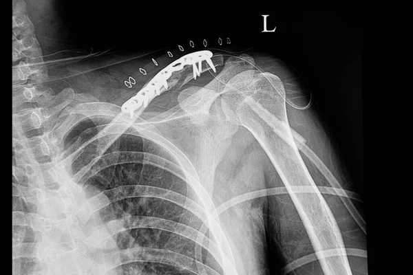 Shoulder Film Xray Patient Fractured Clavicle — Stock Photo, Image