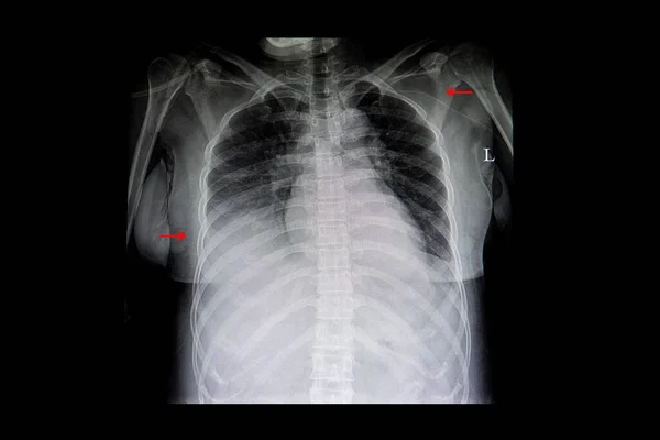 Rechte Lungeninfiltration Und Rechter Herzkatheter — Stockfoto