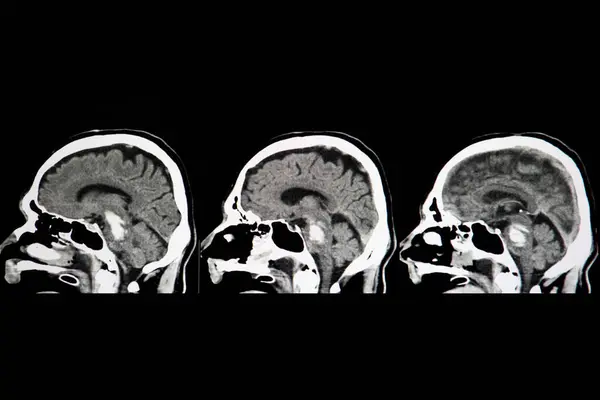 Beyin Sapı Kanaması Röntgen Taraması — Stok fotoğraf