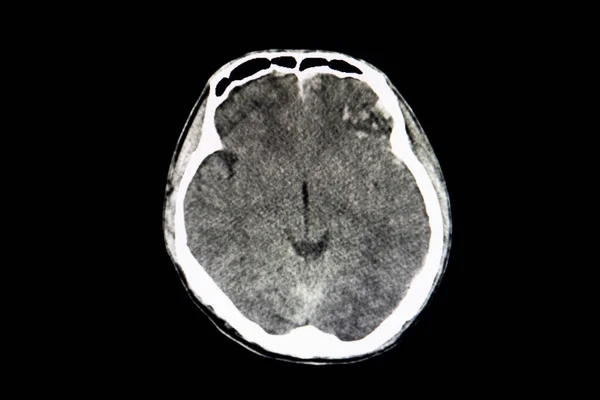 Scanner Cérébral Patient Présentant Une Contusion Hémorragique Bilatérale Radiographie — Photo