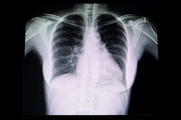 Lungröntgen Film Patient Med Kardiomegali — Stockfoto