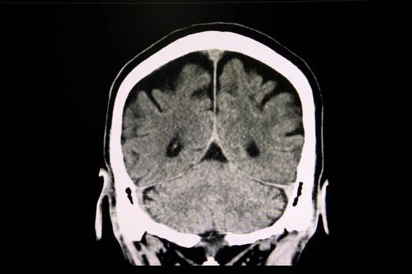 Atrofia Cerebral Exploración Por Rayos — Foto de Stock