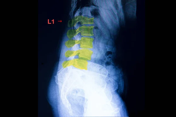 Compression Fracture Lumbar Spine Ray Scan — Stock Photo, Image