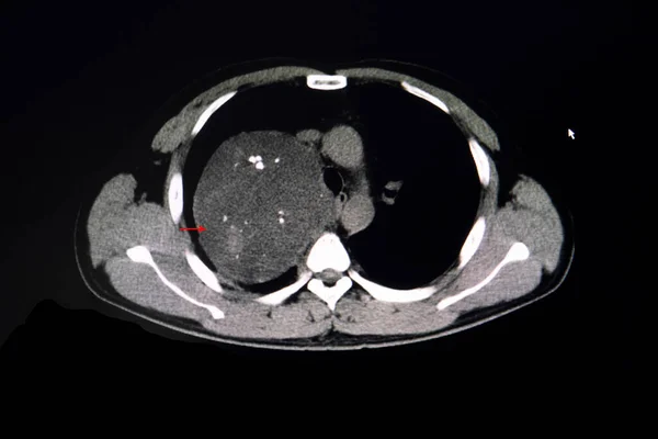 Untersuchung Einer Brust Mit Anteriorem Mediastinalen Tumor — Stockfoto