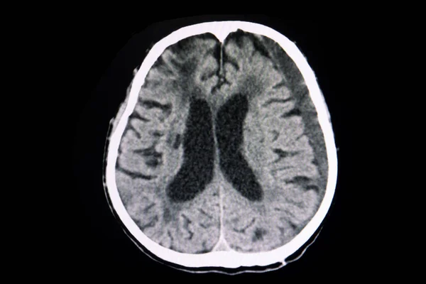 Hematoma Subdural Subagudo Cerebral Por Exploración Por Rayos — Foto de Stock